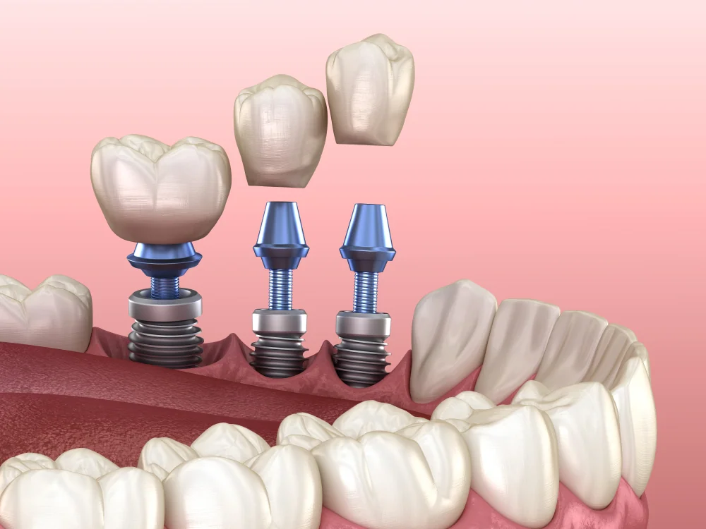 Dental Implants: Cost, Types and Procedure